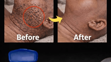 Top 5 Common Antibiotics You Should Know: Their Uses and Why They Matter