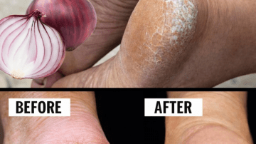 8 Silent Kidney Killers You’re Probably Eating After 50 (And How to Stop Before It’s Too Late)